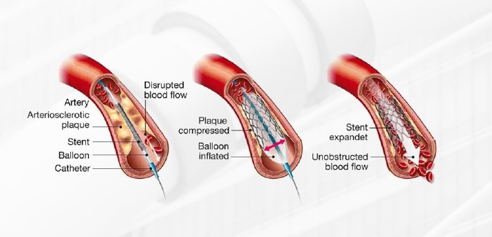Coronary Angiography & Angioplasty