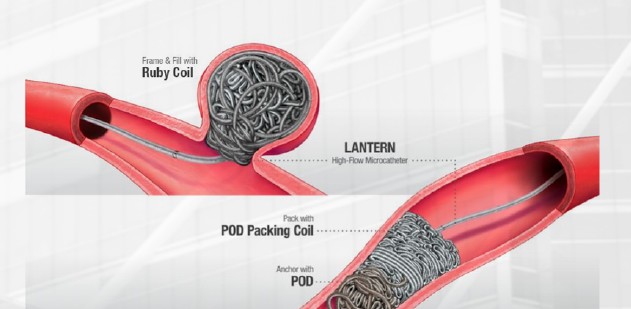 Embolization Procedures
