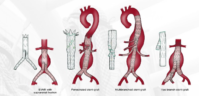 Endovascular Aortic Repair (EVAR)