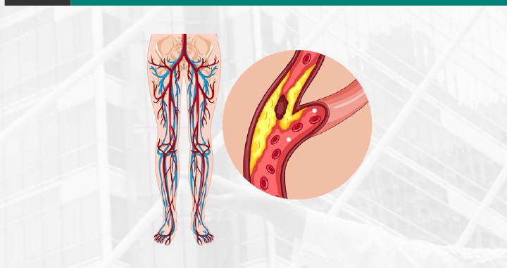 Peripheral Vascular Interventions