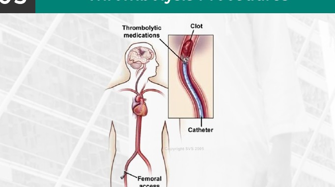 Thrombolysis Procedures